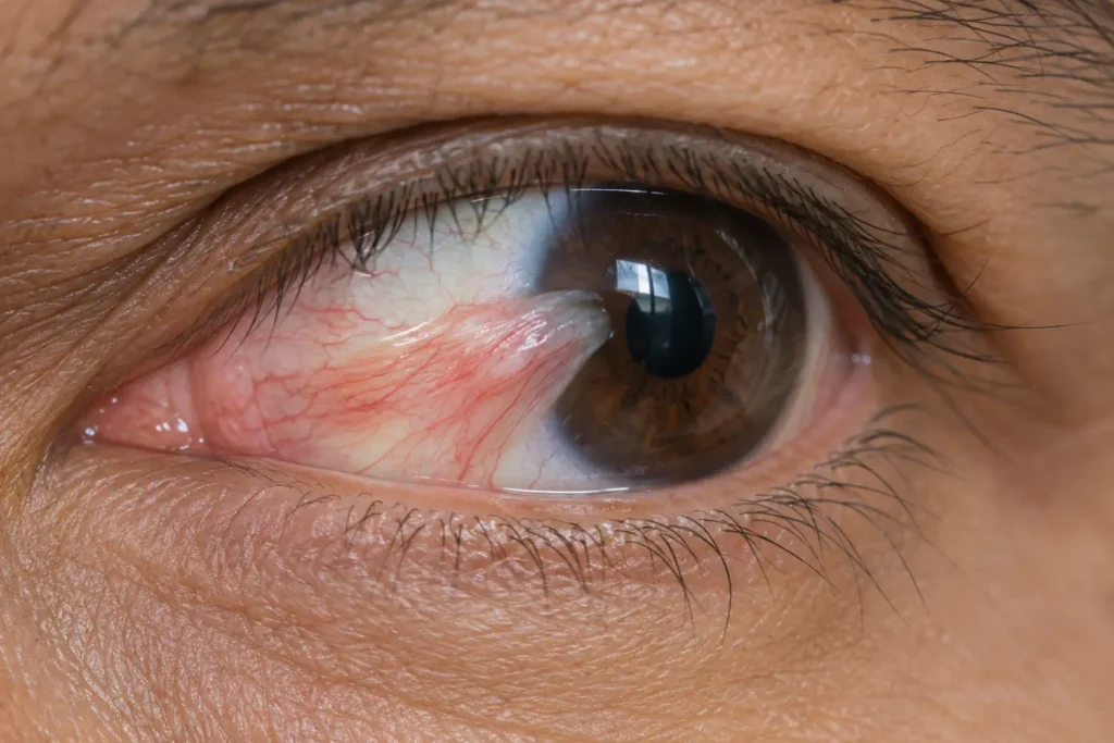 Close-Up Eye with Pterygium-Pterygium Eye Surgery1