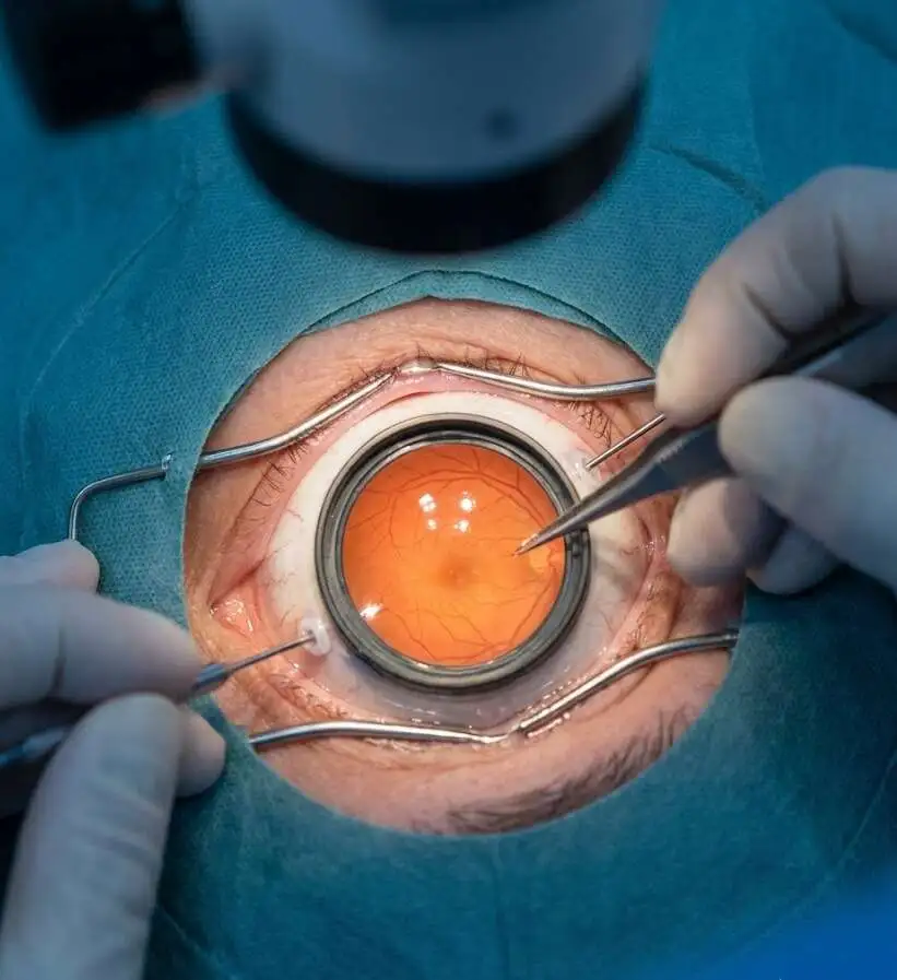 Top-down microscopic view of an ophthalmic surgical procedure showing a surgeon meticulously repairing a patient's retina using micro-instruments - Vitrectomy Eye Surgery - 2