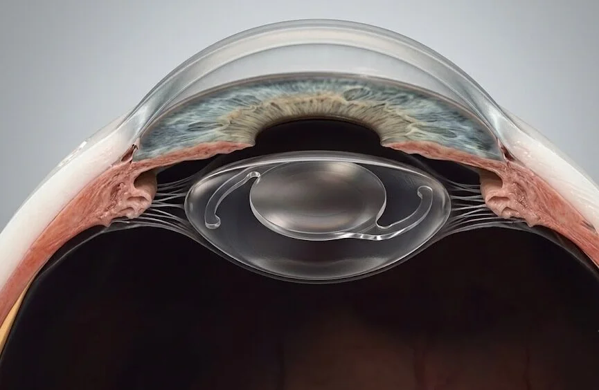 Side cross-section of eye showing injector tool inserting and unfolding a small foldable PCIOL through a corneal incision - PCIOL eye surgery- 2