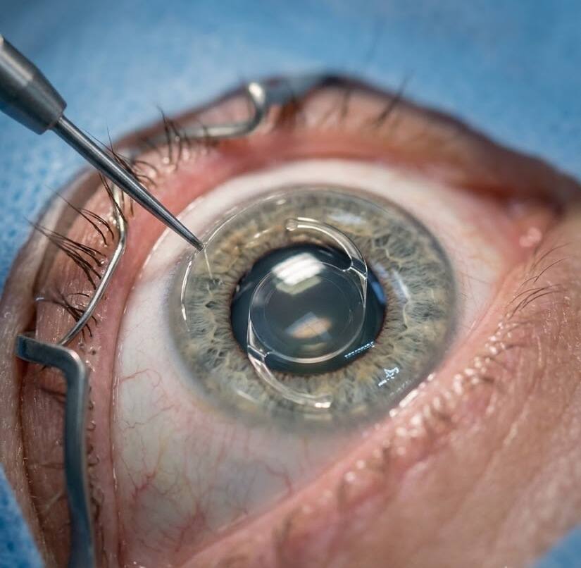 Extreme close-up macro view through a surgical microscope of an instrument at the corneal incision during micro-incision cataract surgery - MICS Eye Surgery -2